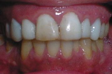 Before Veneers