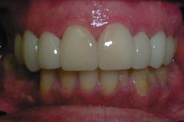 8 Cerinate Veneers