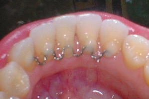 permanent lower retainer